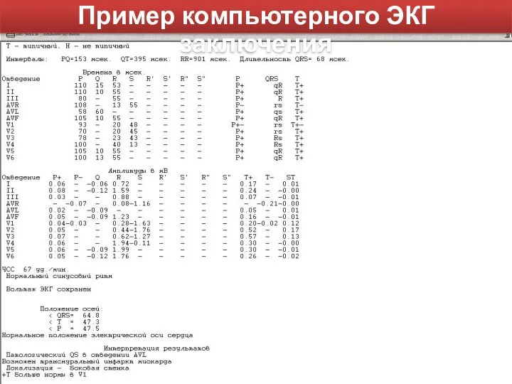 Пример компьютерного ЭКГ заключения