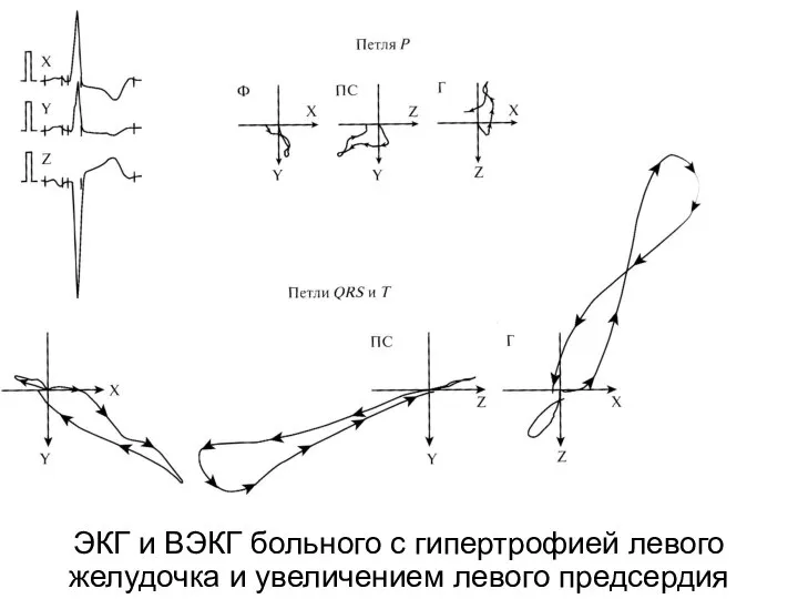 ЭКГ и ВЭКГ больного с гипертрофией левого желудочка и увеличением левого предсердия