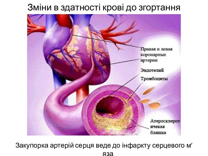 Зміни в здатності крові до згортання Закупорка артерій серця веде до інфаркту серцевого м’яза