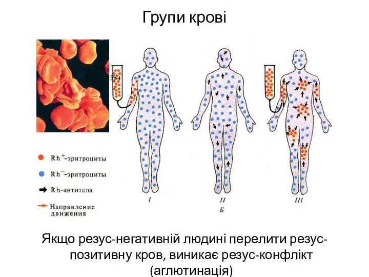 Групи крові Якщо резус-негативній людині перелити резус-позитивну кров, виникає резус-конфлікт (аглютинація)