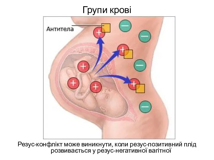 Групи крові Резус-конфлікт може виникнути, коли резус-позитивний плід розвивається у резус-негативної вагітної