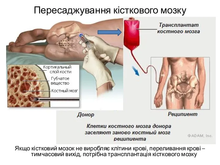 Пересаджування кісткового мозку Якщо кістковий мозок не виробляє клітини крові, переливання