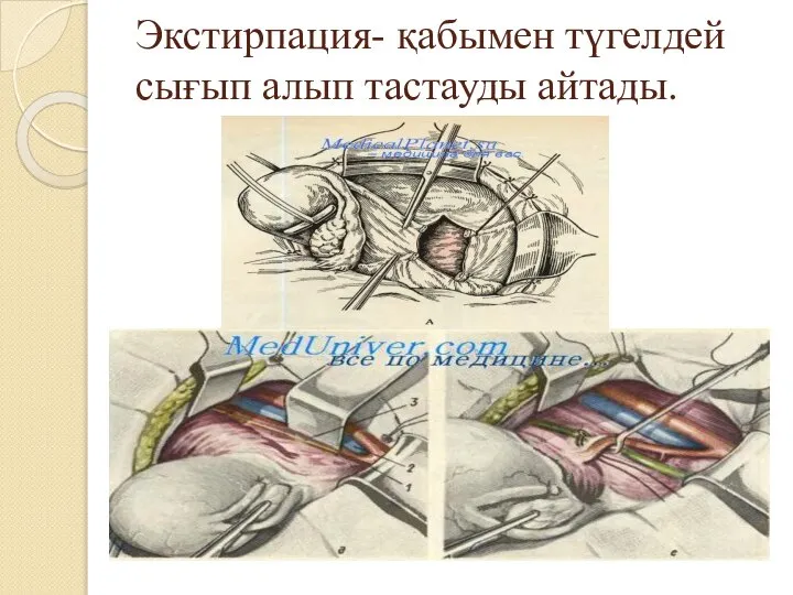 Экстирпация- қабымен түгелдей сығып алып тастауды айтады.