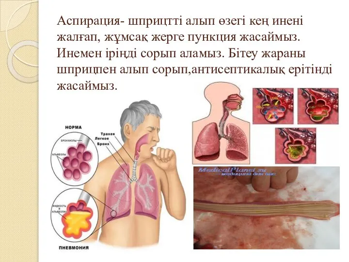 Аспирация- шприцтті алып өзегі кең инені жалғап, жұмсақ жерге пункция жасаймыз.