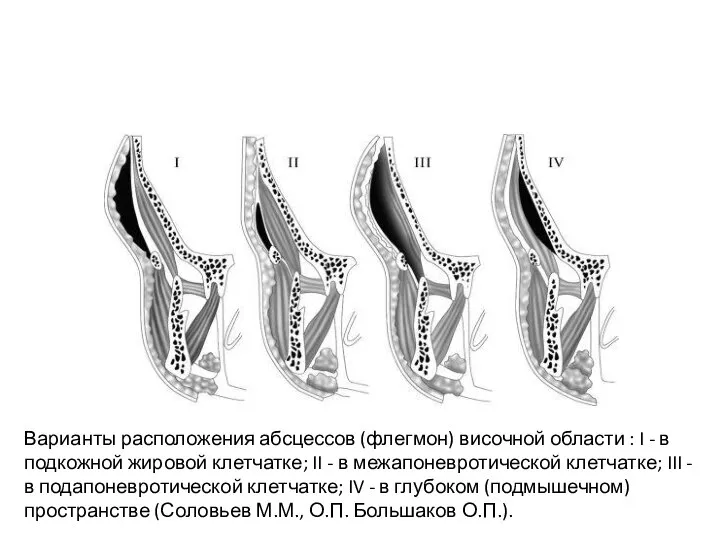 Варианты расположения абсцессов (флегмон) височной области : I - в подкожной