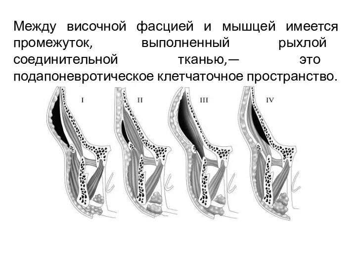 Между височной фасцией и мышцей имеется промежуток, выполненный рыхлой соединительной тканью,— это подапоневротическое клетчаточное пространство.