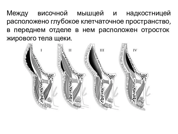 Между височной мышцей и надкостницей расположено глубокое клетчаточное пространство, в переднем