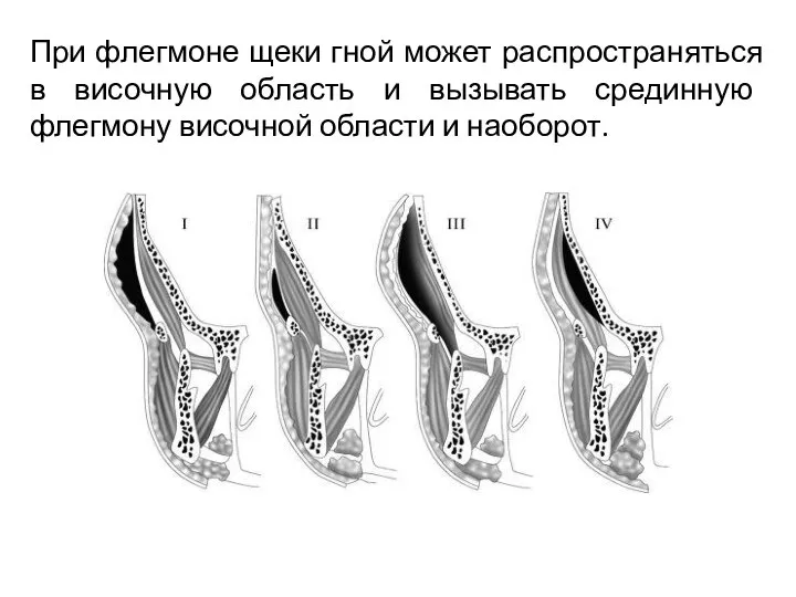 При флегмоне щеки гной может распространяться в височную область и вызывать