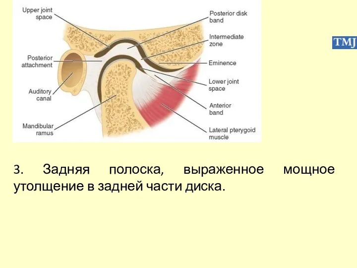 3. Задняя полоска, выраженное мощное утолщение в задней части диска.