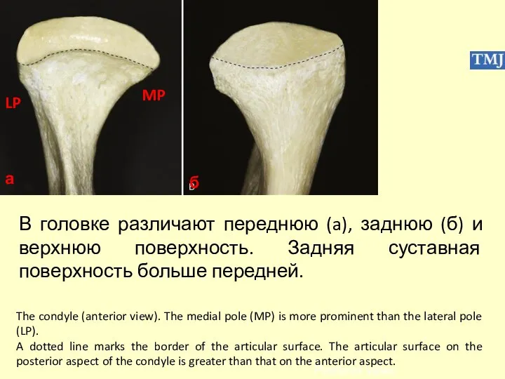 The condyle (anterior view). The medial pole (MP) is more prominent