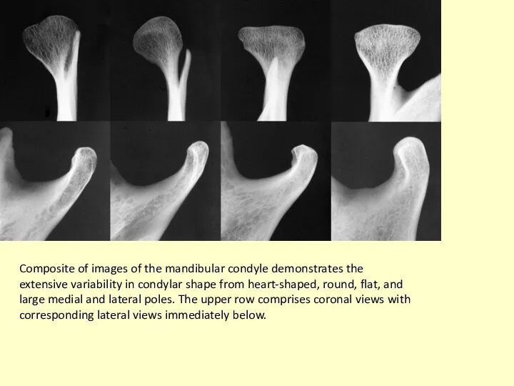 Composite of images of the mandibular condyle demonstrates the extensive variability