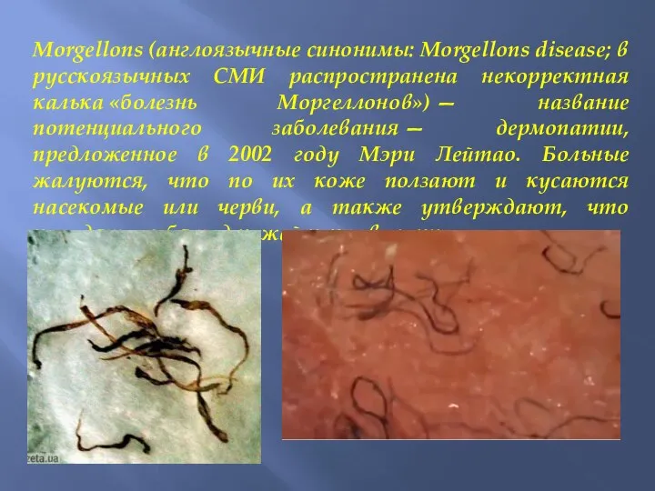 Morgellons (англоязычные синонимы: Morgellons disease; в русскоязычных СМИ распространена некорректная калька