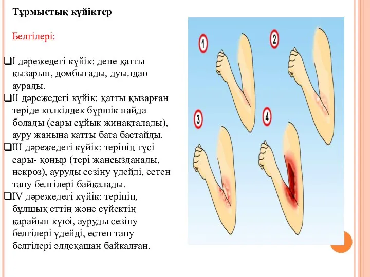 Тұрмыстық күйіктер Белгілері: І дәрежедегі күйік: дене қатты қызарып, домбығады, дуылдап