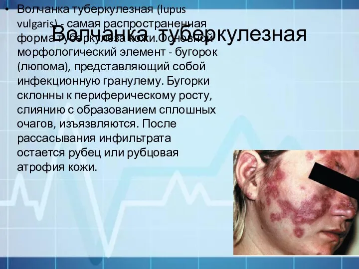 Волчанка туберкулезная Волчанка туберкулезная (lupus vulgaris) - самая распространенная форма туберкулеза