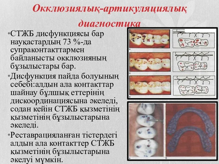 Окклюзиялық-артикуляциялық диагностика СТЖБ дисфункциясы бар науқастардың 73 %-да супраконтакттармен байланысты окклюзияның