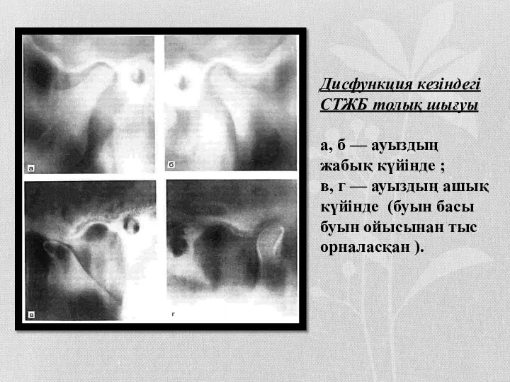 Дисфункция кезіндегі СТЖБ толық шығуы а, б — ауыздың жабық күйінде