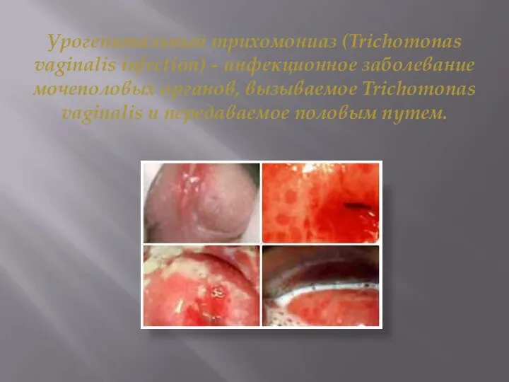 Урогенитальный трихомониаз (Trichomonas vaginalis infection) - инфекционное заболевание мочеполовых органов, вызываемое