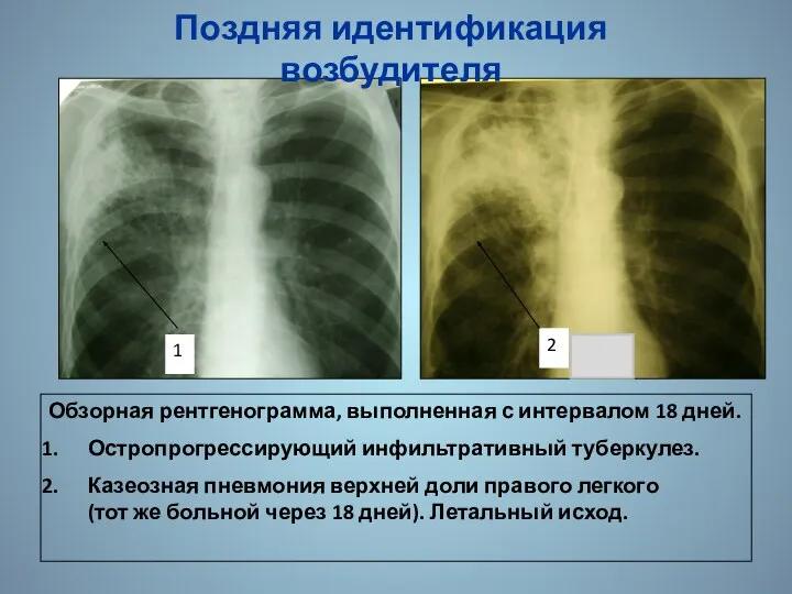 Обзорная рентгенограмма, выполненная с интервалом 18 дней. Остропрогрессирующий инфильтративный туберкулез. Казеозная