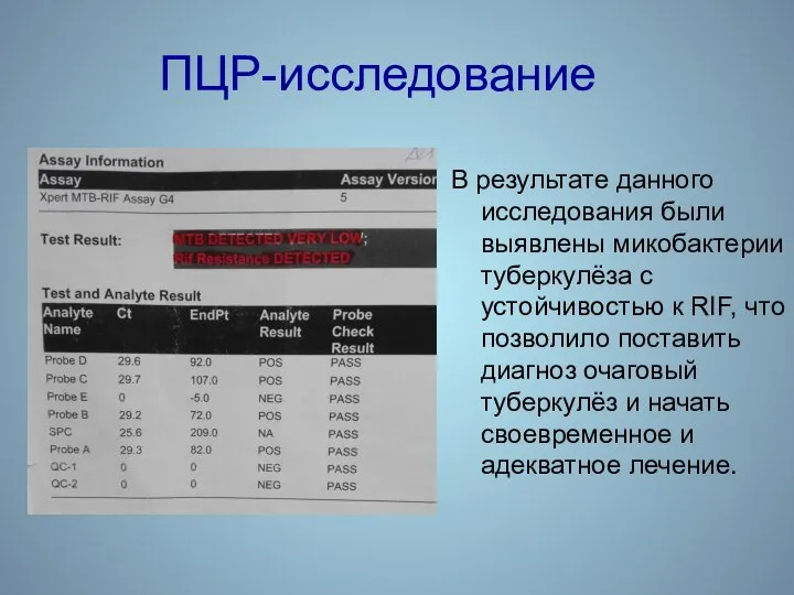 ПЦР-исследование В результате данного исследования были выявлены микобактерии туберкулёза с устойчивостью