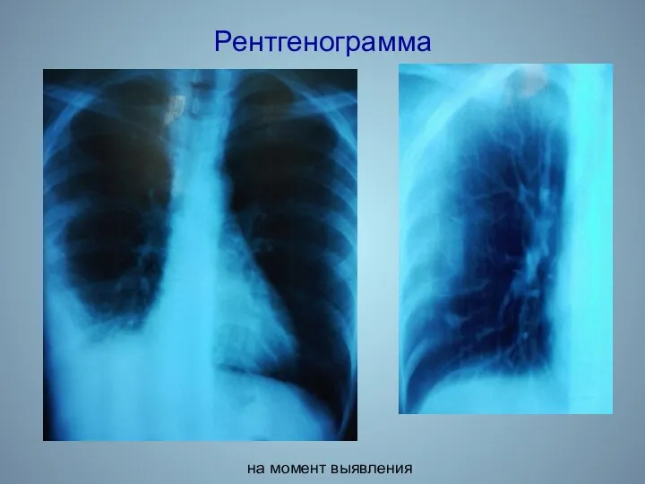 Рентгенограмма на момент выявления