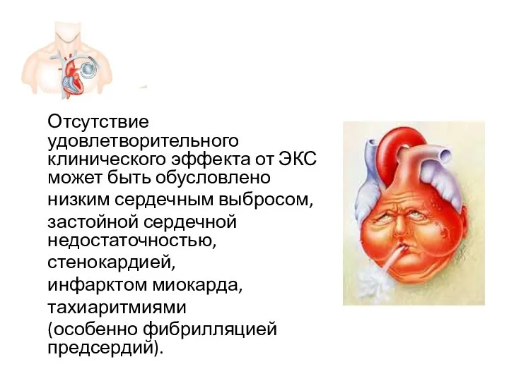 Отсутствие удовлетворительного клинического эффекта от ЭКС может быть обусловлено низким сердечным