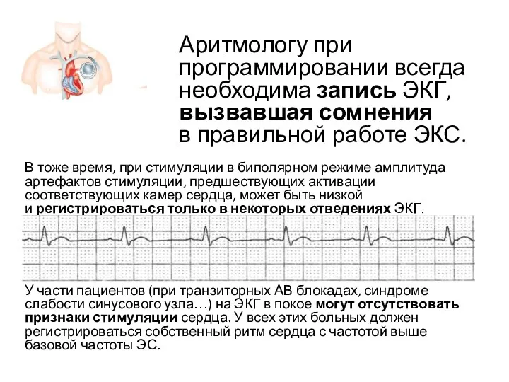 В тоже время, при стимуляции в биполярном режиме амплитуда артефактов стимуляции,