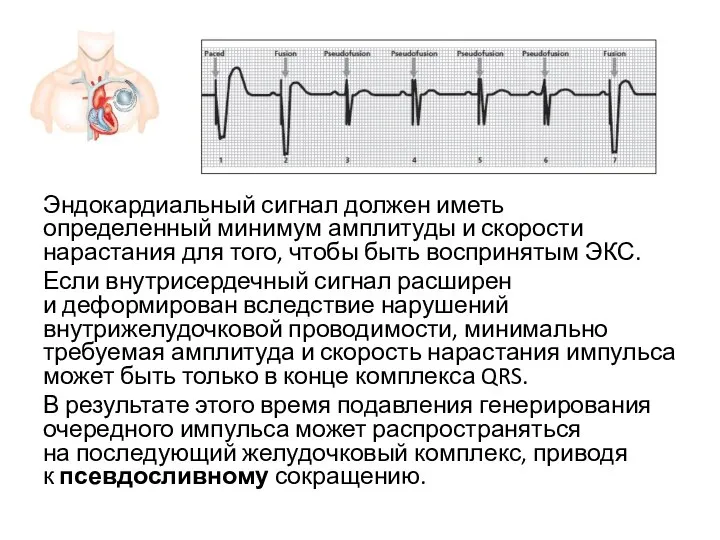 Эндокардиальный сигнал должен иметь определенный минимум амплитуды и скорости нарастания для