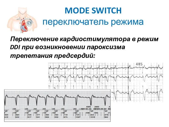 MODE SWITCH переключатель режима Переключение кардиостимулятора в режим DDI при возникновении пароксизма трепетания предсердий: