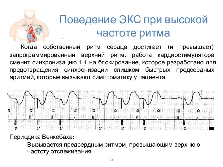 Поведение ЭКС при высокой частоте ритма Когда собственный ритм сердца достигает