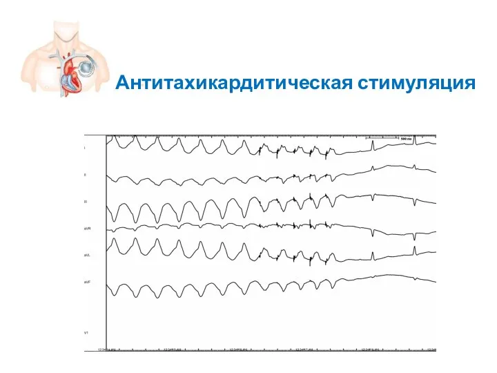 Антитахикардитическая стимуляция