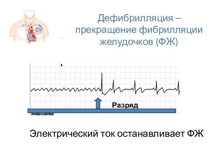 Дефибрилляция – прекращение фибрилляции желудочков (ФЖ) Разряд Электрический ток останавливает ФЖ