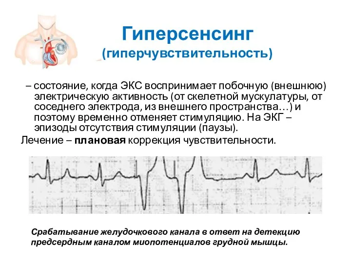 Гиперсенсинг (гиперчувствительность) – состояние, когда ЭКС воспринимает побочную (внешнюю) электрическую активность