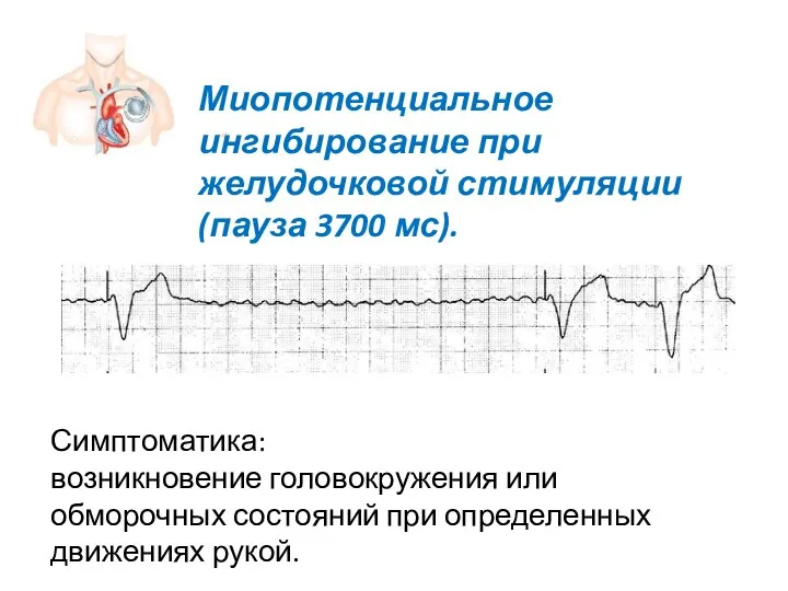 Миопотенциальное ингибирование при желудочковой стимуляции (пауза 3700 мс). Симптоматика: возникновение головокружения