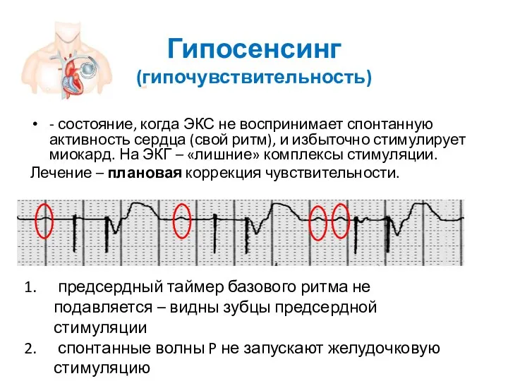 Гипосенсинг (гипочувствительность) - состояние, когда ЭКС не воспринимает спонтанную активность сердца