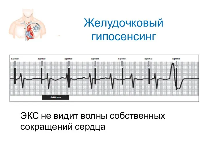 Желудочковый гипосенсинг ЭКС не видит волны собственных сокращений сердца