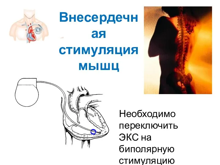 Внесердечная стимуляция мышц Необходимо переключить ЭКС на биполярную стимуляцию