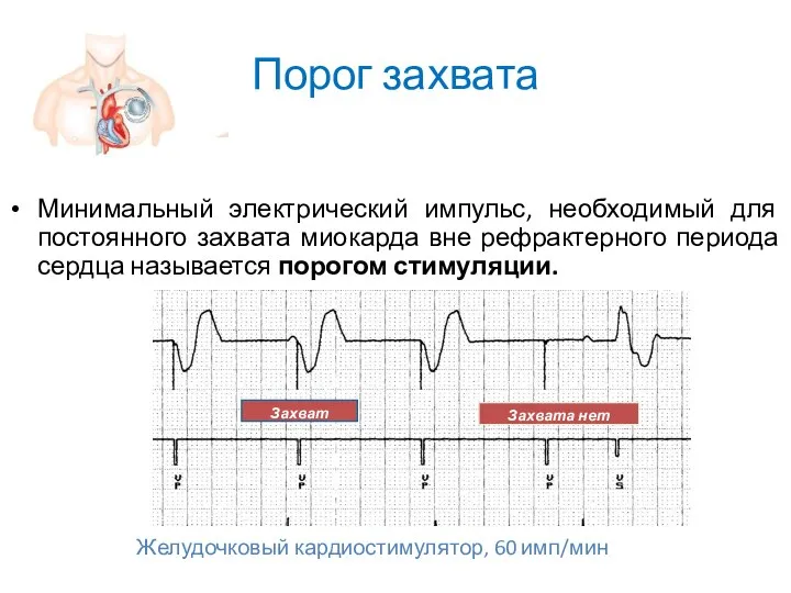 Порог захвата Минимальный электрический импульс, необходимый для постоянного захвата миокарда вне