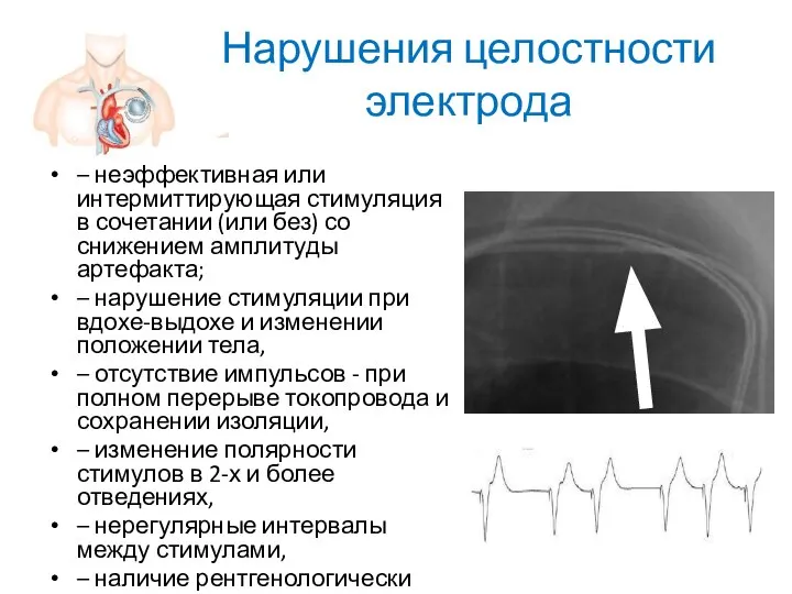 Нарушения целостности электрода – неэффективная или интермиттирующая стимуляция в сочетании (или