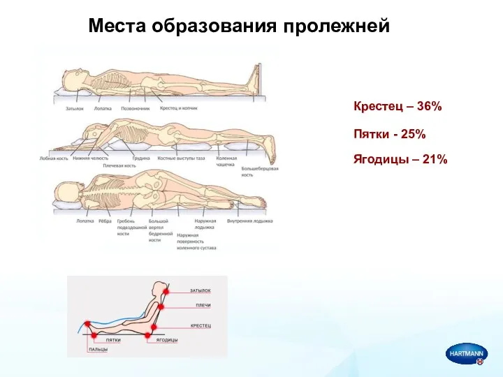 Места образования пролежней Крестец – 36% Пятки - 25% Ягодицы – 21%