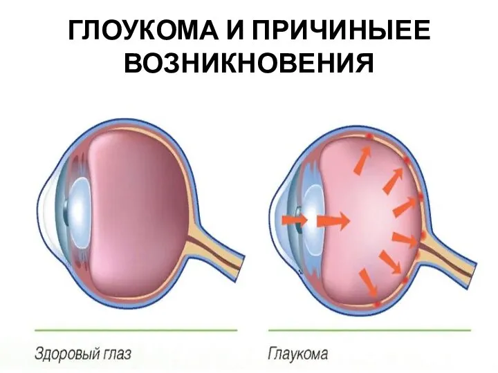 ГЛОУКОМА И ПРИЧИНЫЕЕ ВОЗНИКНОВЕНИЯ