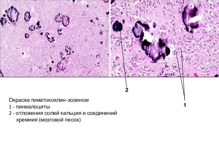 Окраска гематоксилин-эозином 1 - пинеалоциты 2 - отложения солей кальция и