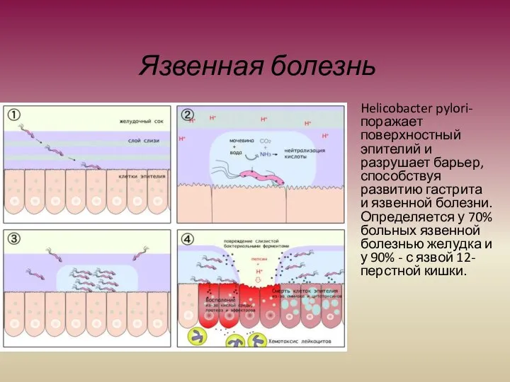 Язвенная болезнь Helicobacter pylori- поражает поверхностный эпителий и разрушает барьер, способствуя