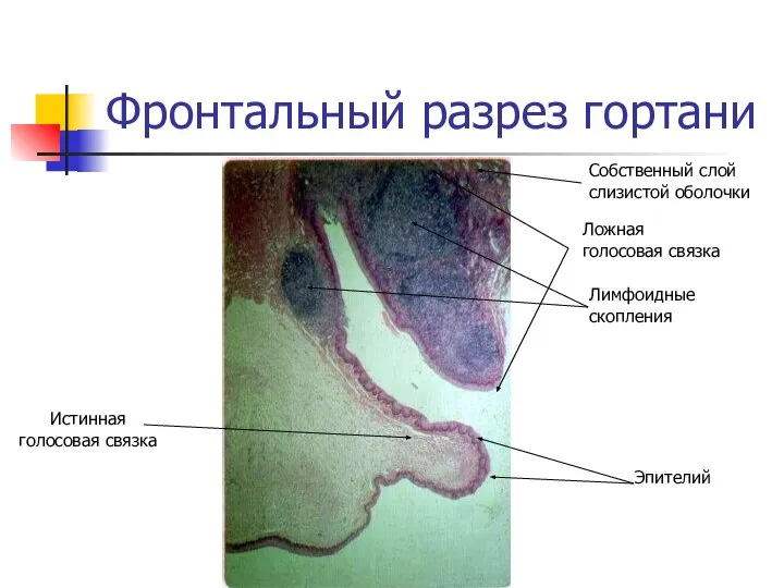 Фронтальный разрез гортани Ложная голосовая связка Собственный слой слизистой оболочки Лимфоидные скопления Истинная голосовая связка Эпителий