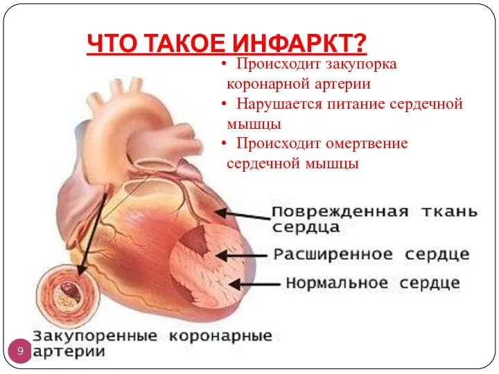 ЧТО ТАКОЕ ИНФАРКТ? Происходит закупорка коронарной артерии Нарушается питание сердечной мышцы Происходит омертвение сердечной мышцы