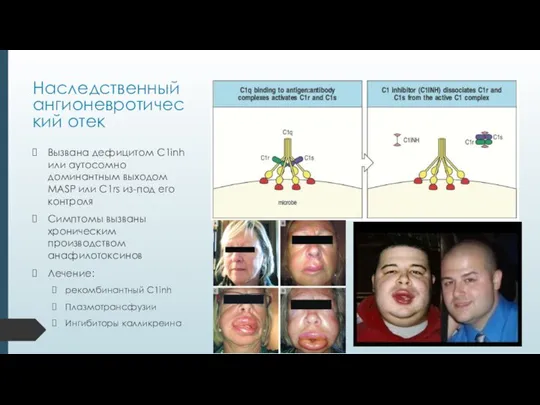 Наследственный ангионевротический отек Вызвана дефицитом C1inh или аутосомно доминантным выходом MASP