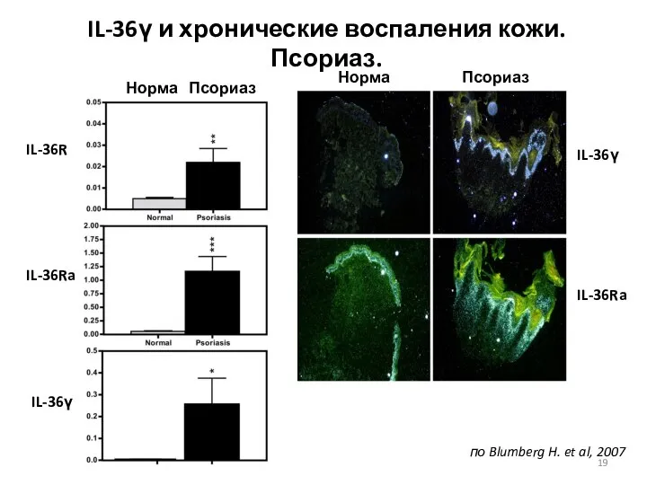 IL-36γ и хронические воспаления кожи. Псориаз. по Blumberg H. et al,