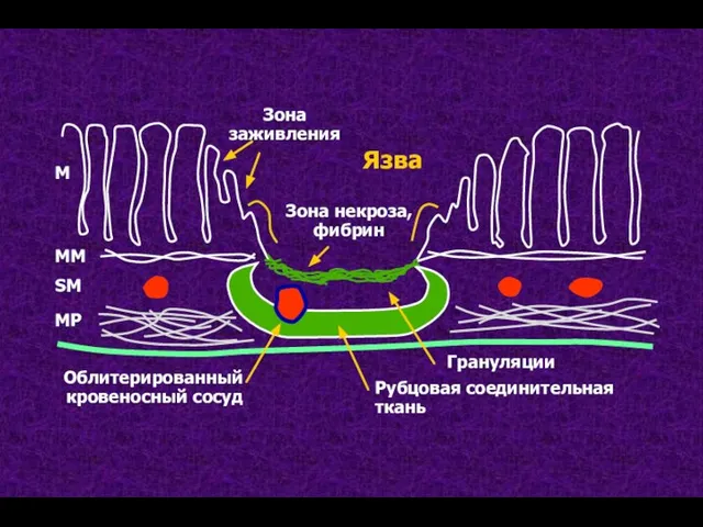 Облитерированный кровеносный сосуд Рубцовая соединительная ткань Грануляции Зона заживления Язва Зона