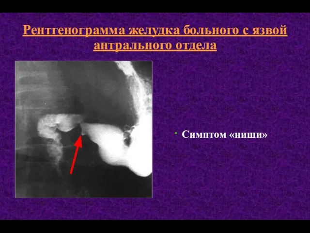 Рентгенограмма желудка больного с язвой антрального отдела Симптом «ниши»