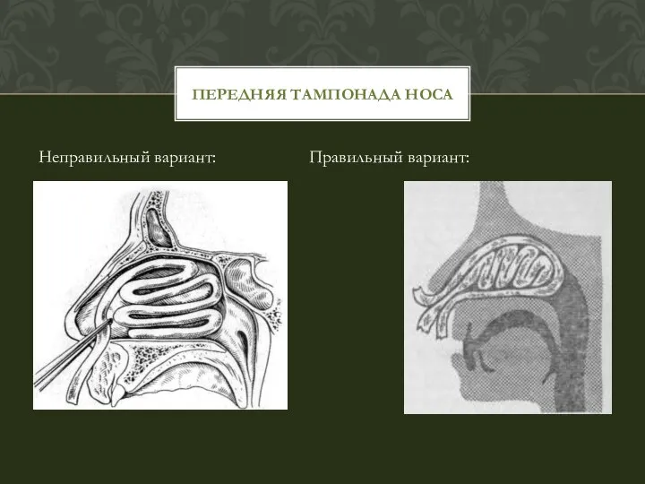 Неправильный вариант: Правильный вариант: ПЕРЕДНЯЯ ТАМПОНАДА НОСА