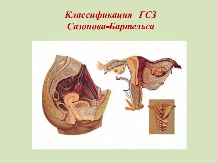 Классификация ГСЗ Сазонова-Бартельса